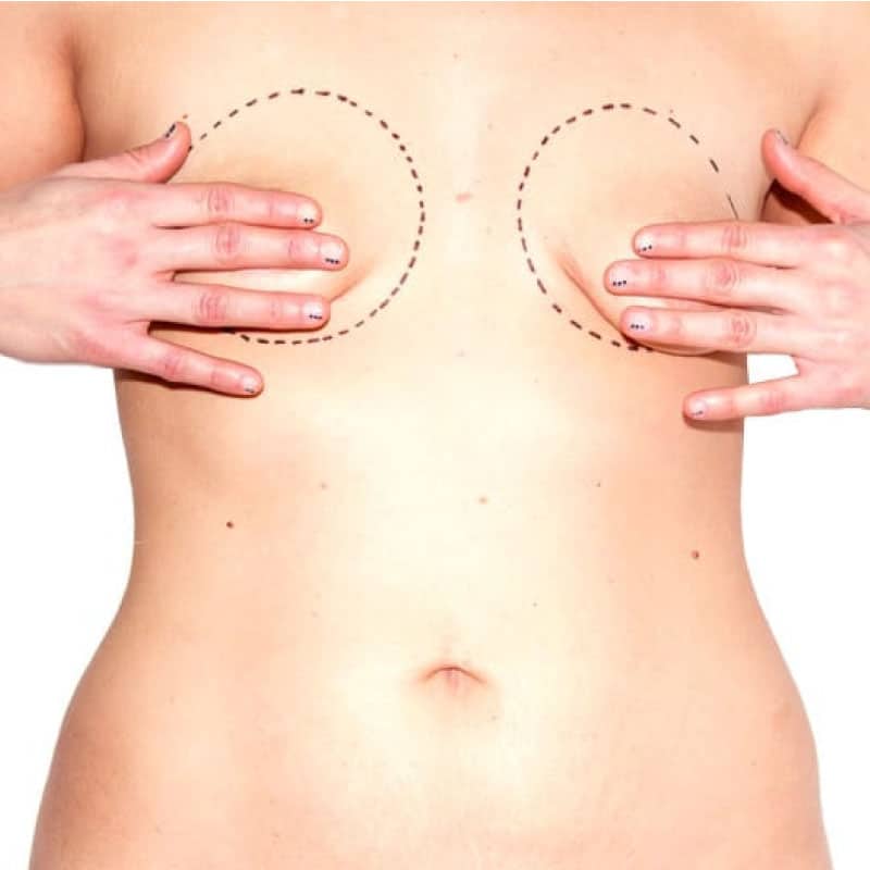 Cirugia-mamas04-tuberosas (1)